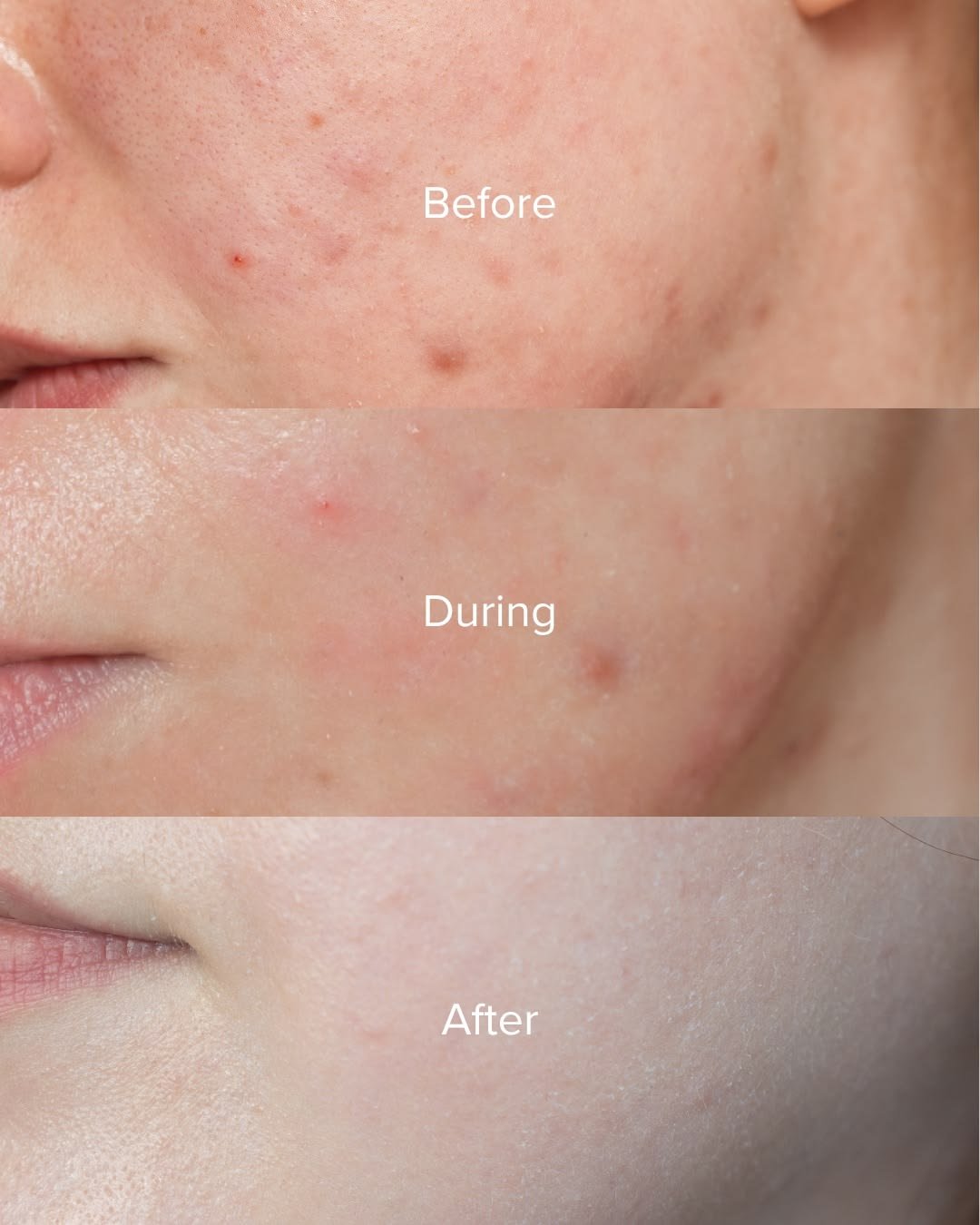 COSRX AC Collection Ultimate Spot Cream 30g product photo